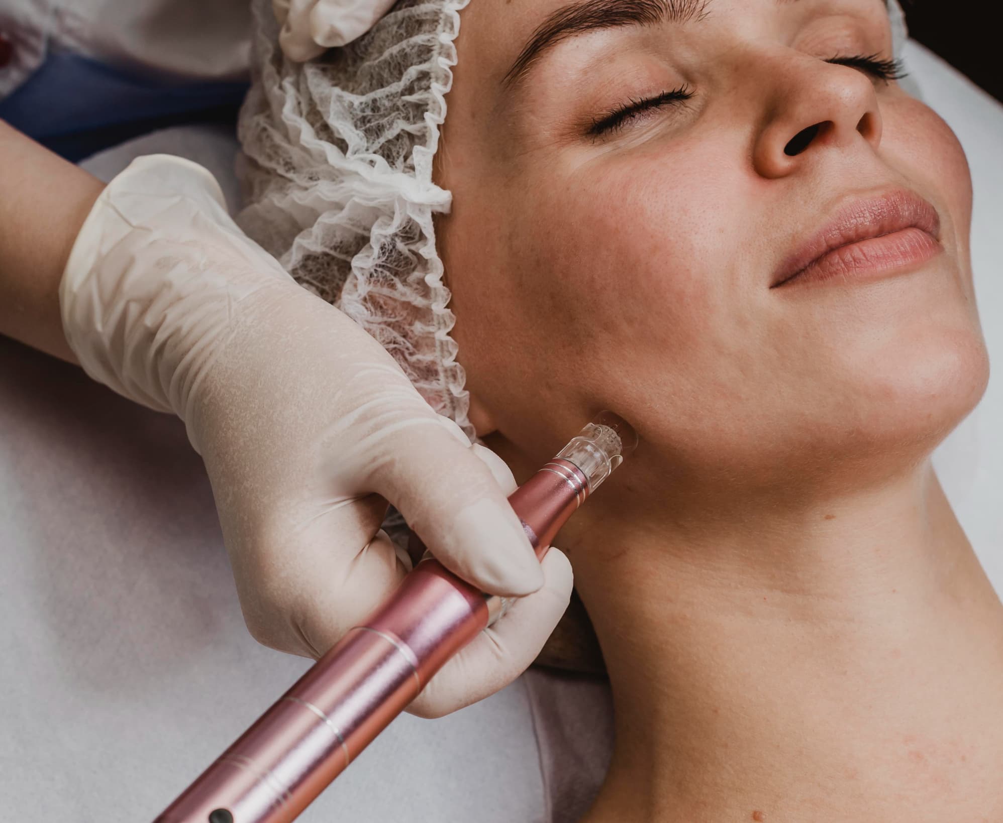 Microneedling Behandlung